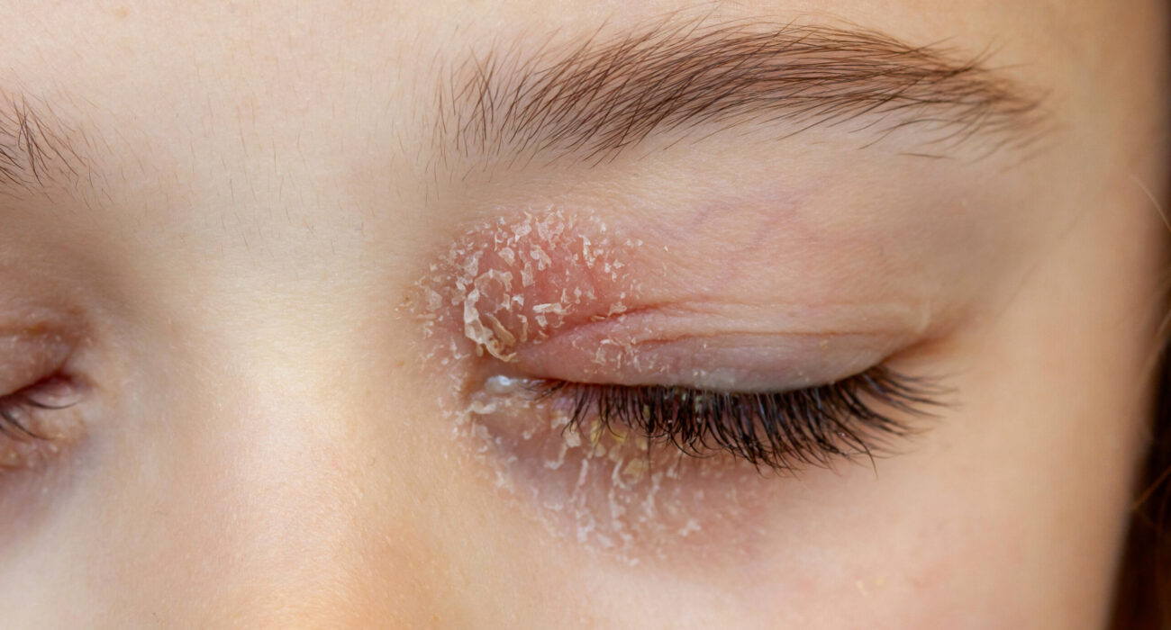 Eyelid Eczema Be Cured With Natural Eye Cream