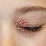 Eyelid Eczema Be Cured With Natural Eye Cream