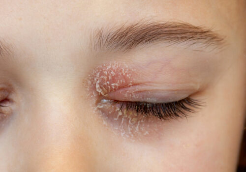 Eyelid Eczema Be Cured With Natural Eye Cream